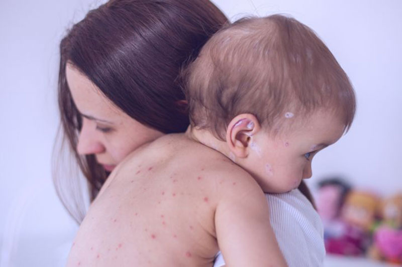 bebe con alergia en la piel en brazos de su mama